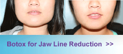 Botox Jaw line