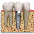 Dental Implant